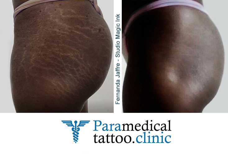 Inkless Stretchmarks Revision - Paramedical Tattoo