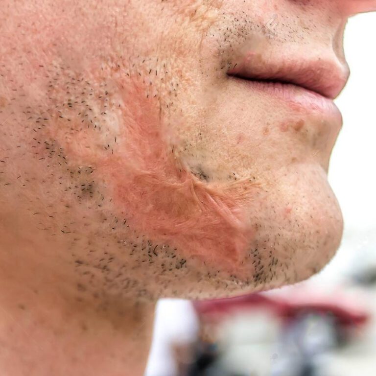 Scar from burn on face men