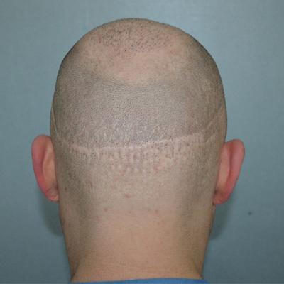 HAIR TRANSPLANT SCAR - Paramedical Tattoo