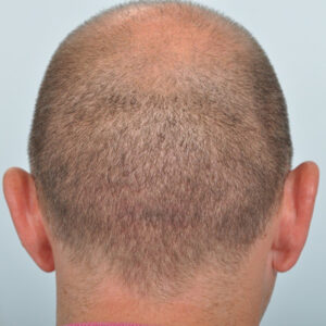 HAIR TRANSPLANT SCAR - Paramedical Tattoo