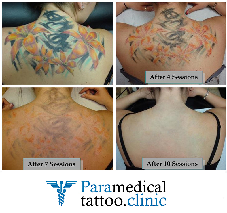 Before and After Tattoo Removal - Get the Best Res (0)