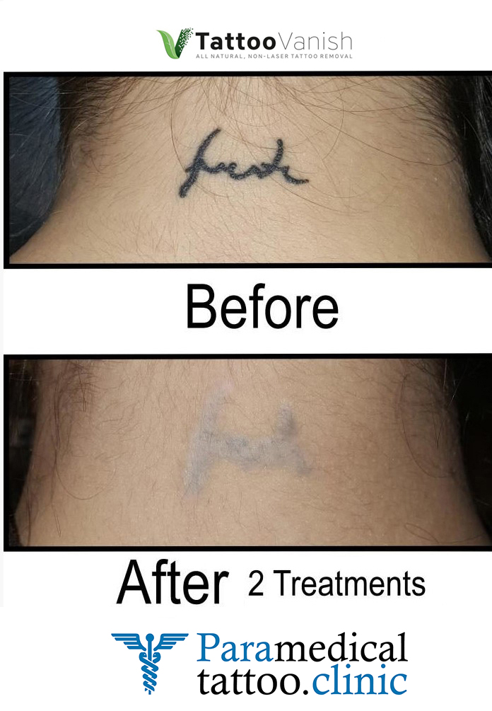 Before and After Tattoo Removal - Get the Best Res (11)