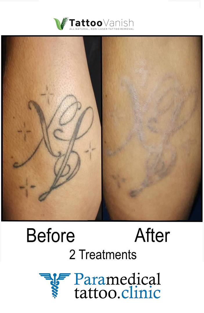 Before and After Tattoo Removal - Get the Best Res (13)