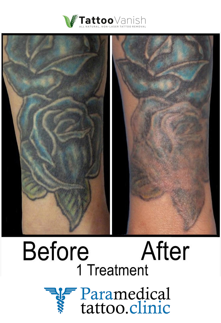 Before and After Tattoo Removal - Get the Best Res (15)
