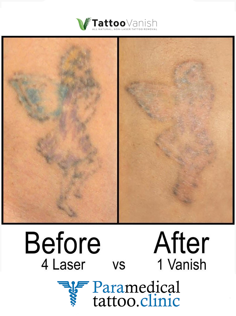 Before and After Tattoo Removal - Get the Best Res (2)