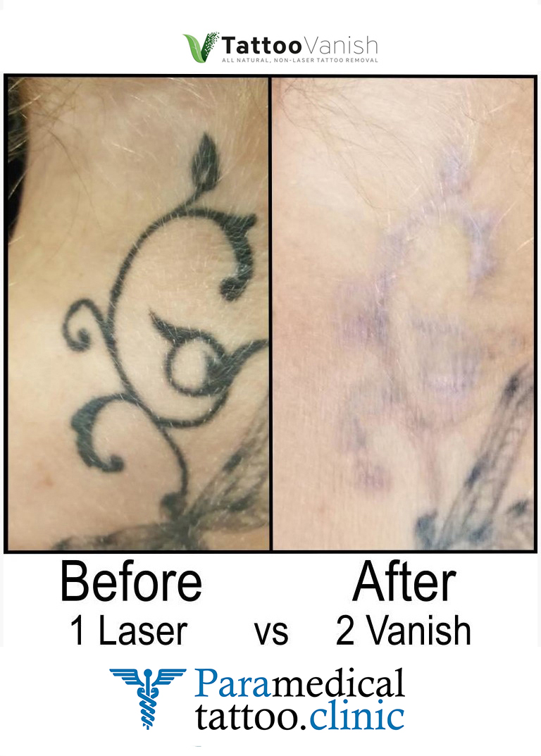 Before and After Tattoo Removal - Get the Best Res (21)