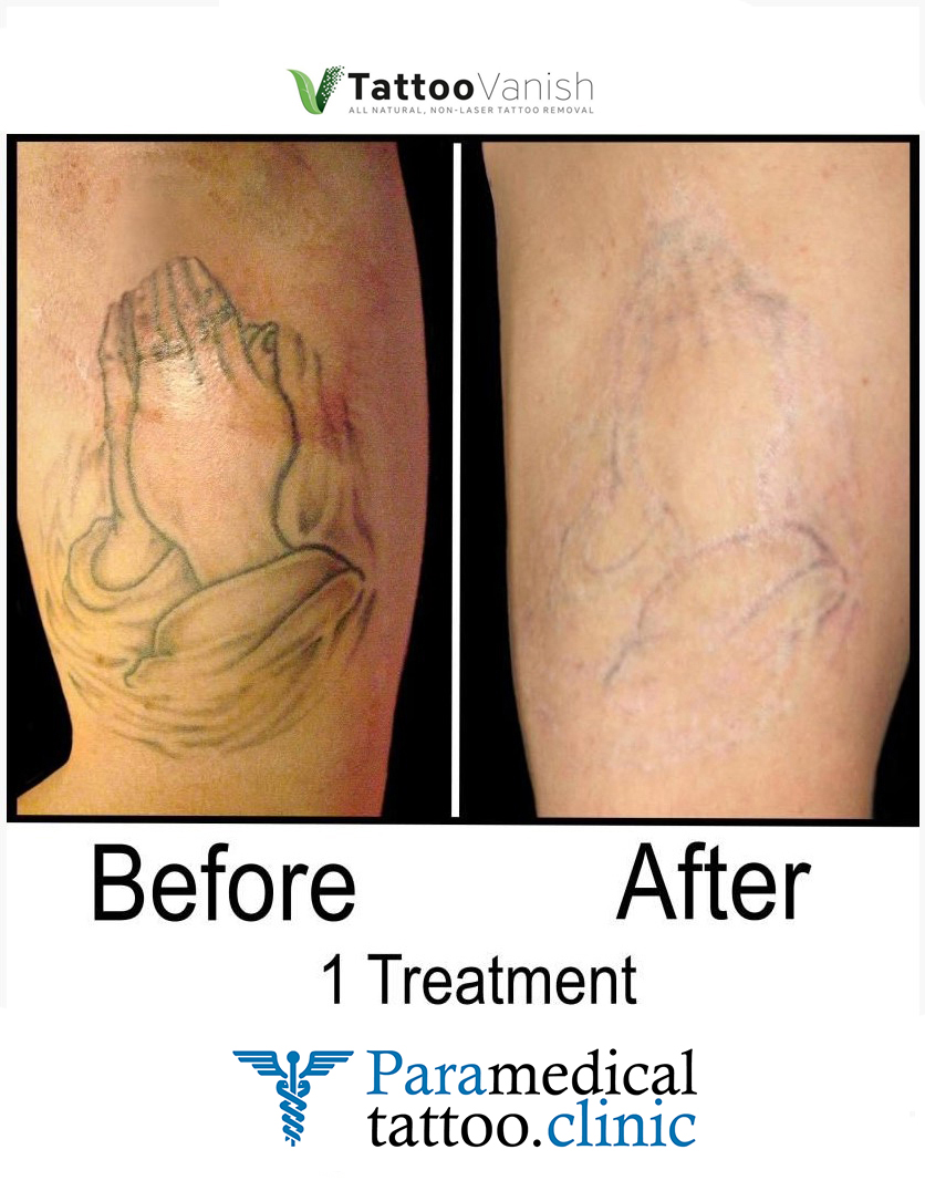 Before and After Tattoo Removal - Get the Best Res (3)