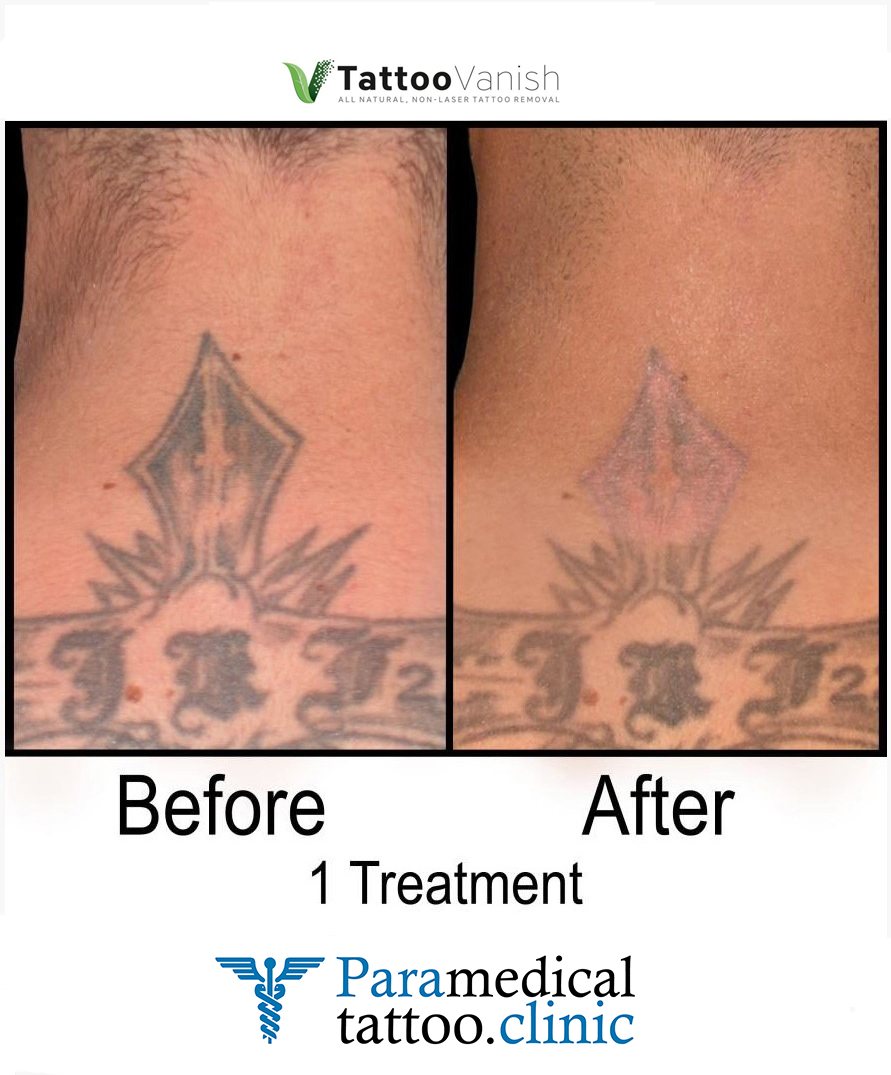 UNDO REMOVAL - non-laser tattoo removal : r/TattooRemoval