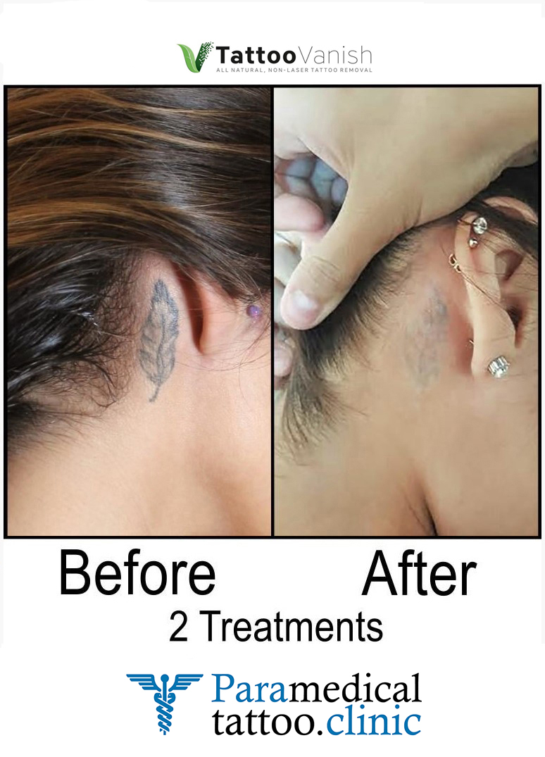 Before and After Tattoo Removal - Get the Best Res (31)