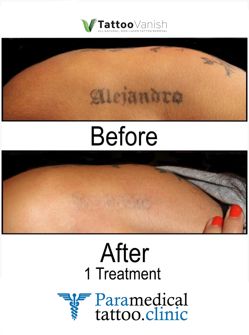 Miami Center for Cosmetic Dermatology  Dr Deborah Longwill Tattoo Removal  Options  Miami Center for Dermatology