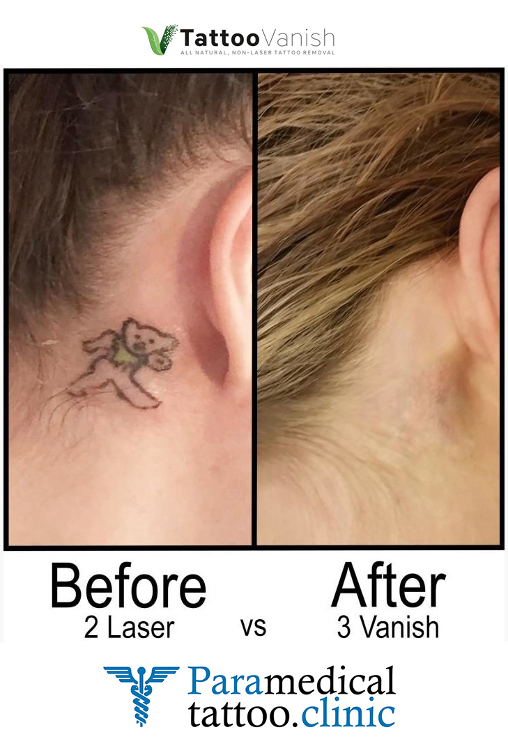 Before and After Tattoo Removal - Get the Best Res (8)