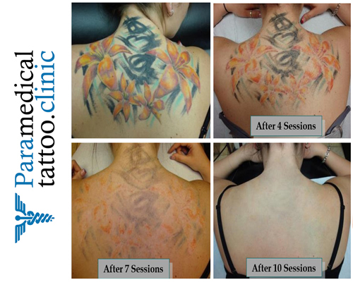 Importance of Paramedical Tattoos for improving the appearance of Hair  Transplant Scars by alodiem - Issuu