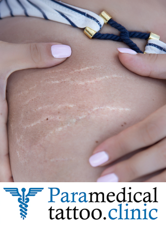 What is the most effective treatment for Stretch Marks? - Ink