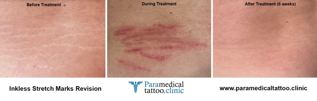 Inkless Stretchmarks Revision - Paramedical Tattoo