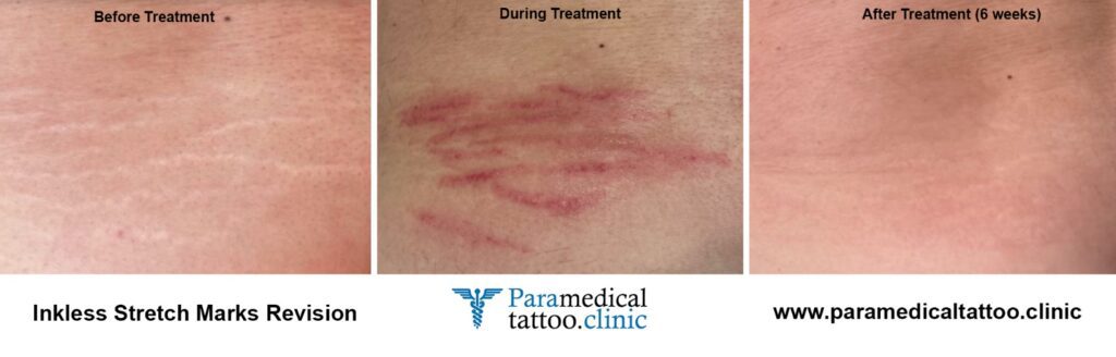 Medical Scar Camouflage Tattoo Treatment in CT [Call NOW]