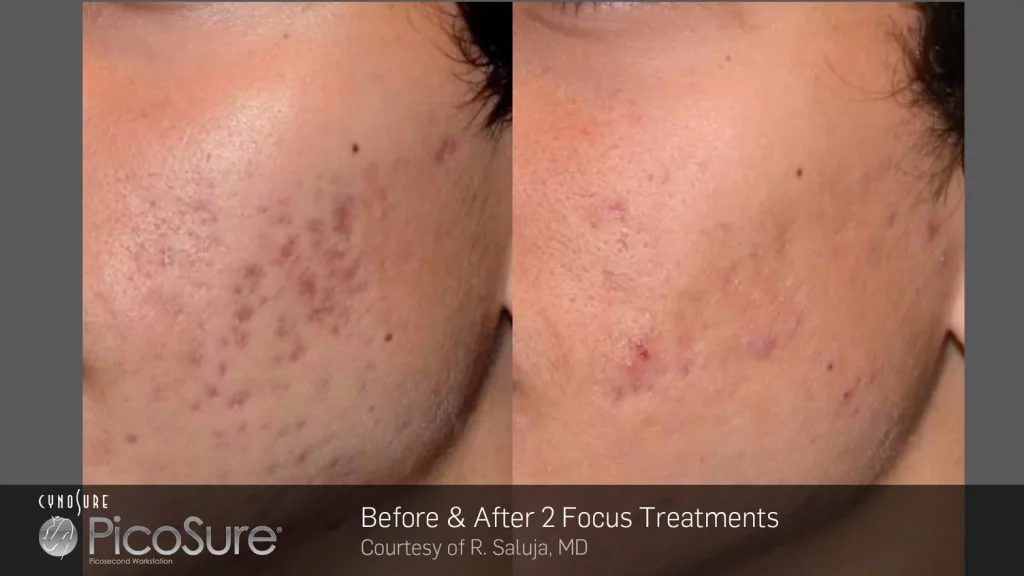 Picosure Laser treatment for acne scars Toronto