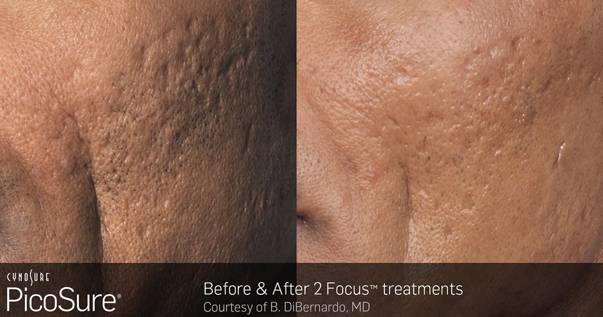Picosure laser treatment for acne scars Toronto