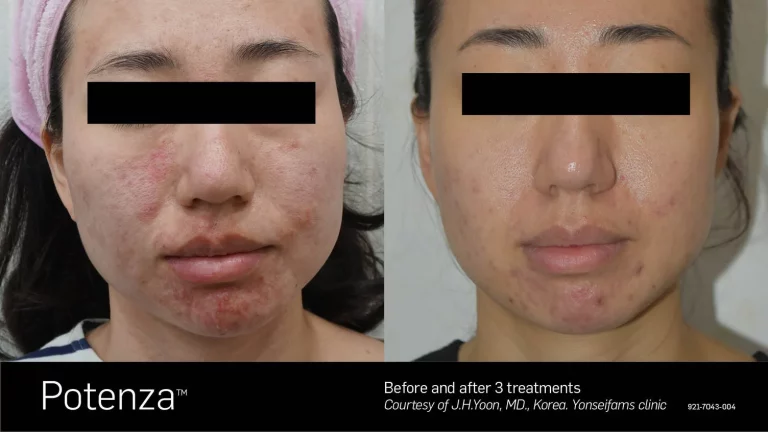 acne scar treatment Toronto (2)