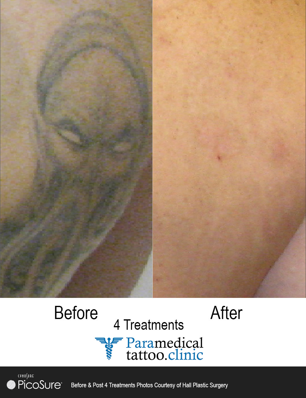 What to Expect During Laser Tattoo Removal  Carr Dermatology