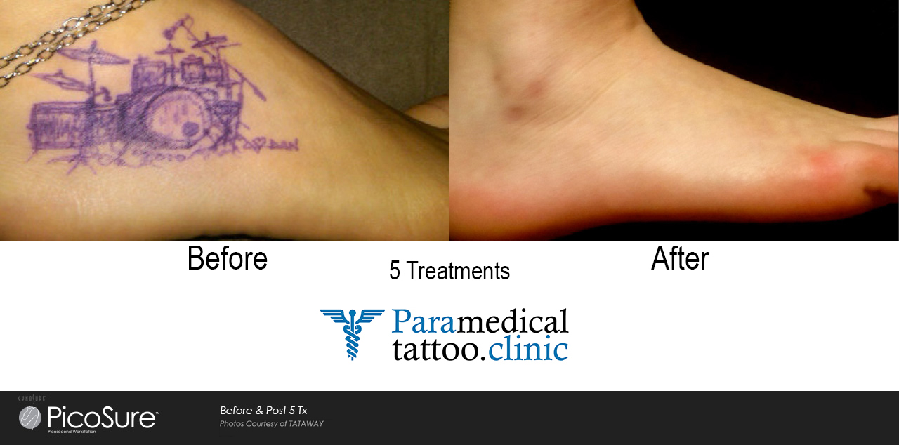 Laser Tattoo Removal - Lakeland, FL: North County Dermatology Clinic:  Dermatologist