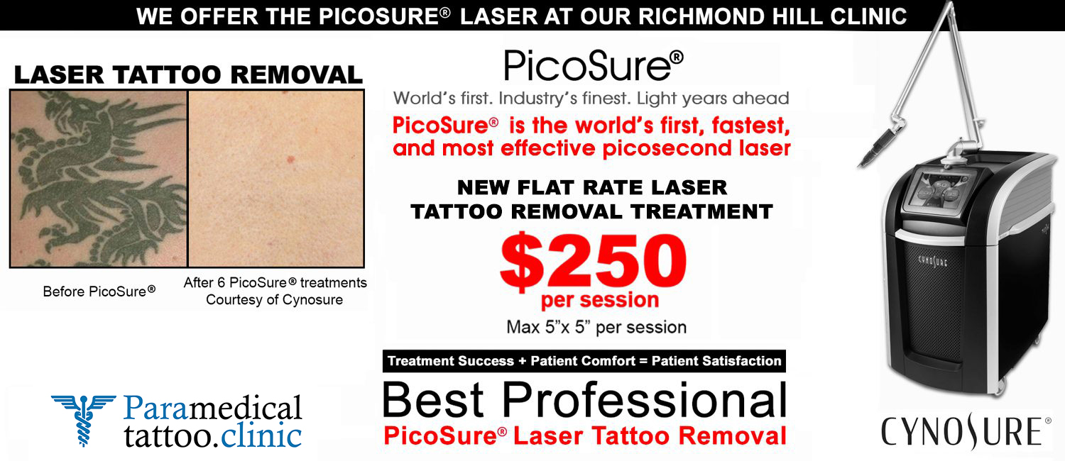 laser tattoo removal before and after Toronto Special