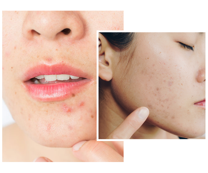 laser treatment for acne scars Toronto CA