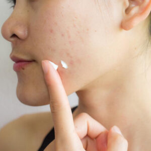 laser treatment for acne scars Toronto Clinic