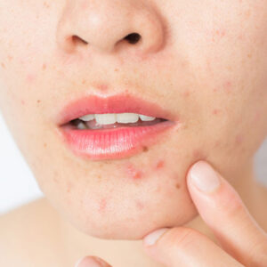 laser treatment for acne scars Toronto ON