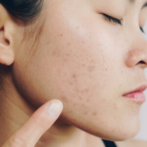 laser treatment for acne scars Toronto Richmond Hill
