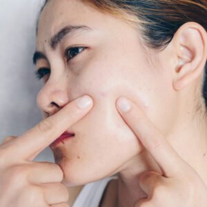 laser treatment for acne scars Toronto