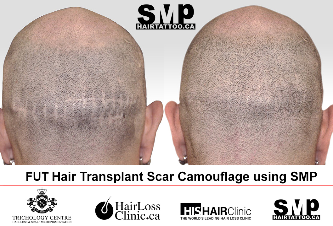 Navigating Scalp Micropigmentation Regrets: Expert Advice