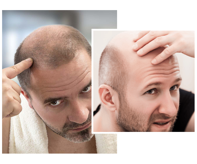 scalp micropigmentation regrets Toronto CA