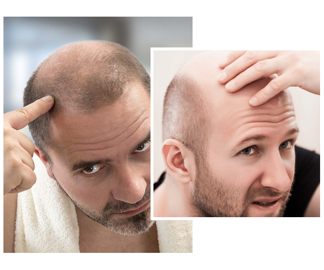 Scalp Micropigmentation Regrets WE REMOVE SMP WITH PICOSURE