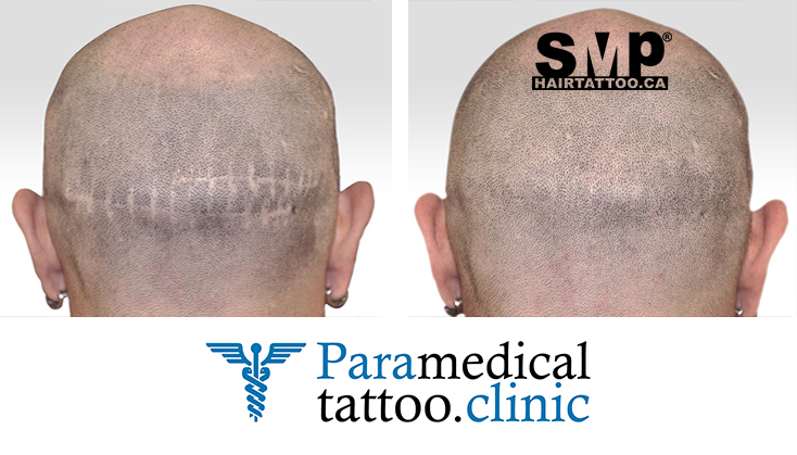 Scalp Micropigmentation 101 What is a Hair Tattoo - HAIRTATTOO