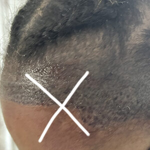 scalp micropigmentation regrets and removal Toronto ON