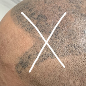 scalp micropigmentation regrets and removal Toronto