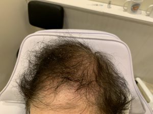 womens hair loss Toronto